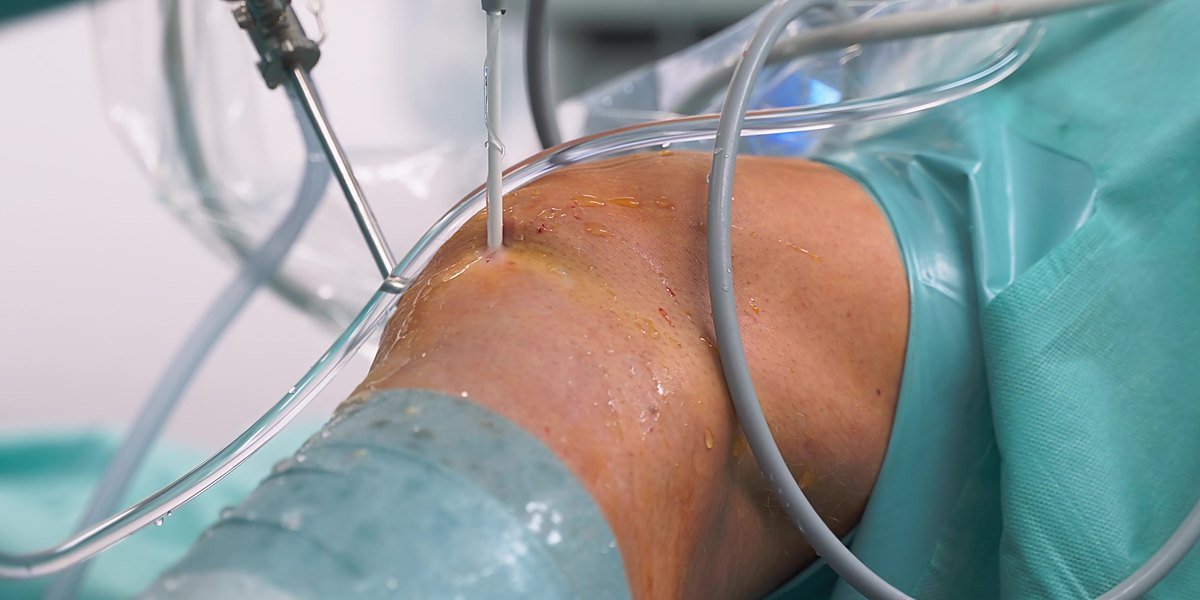 Arthroscopy